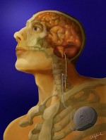 Vagus Nerve Stimulation Pulse Generator